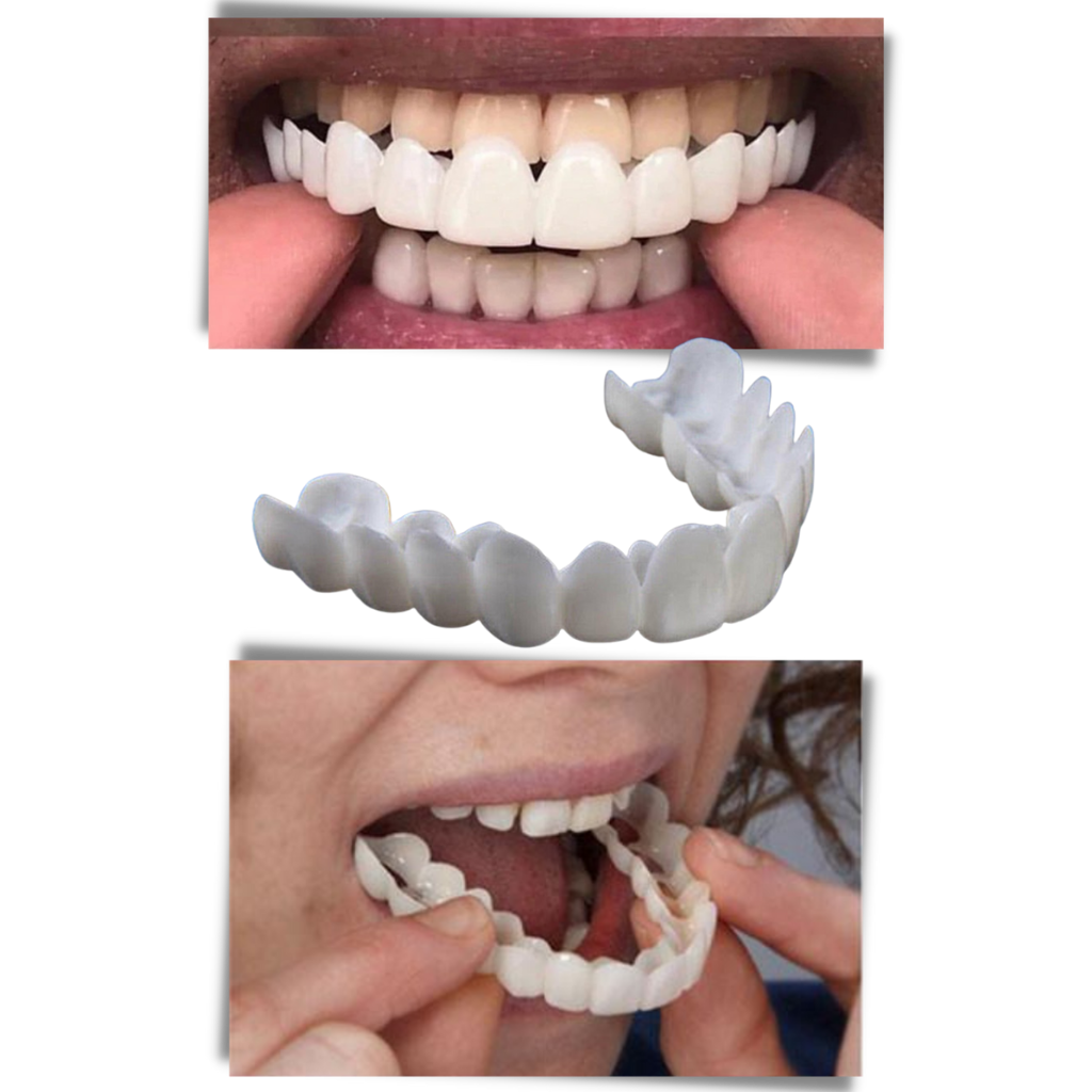 Perfect smile dental coverage - comfortable veneers