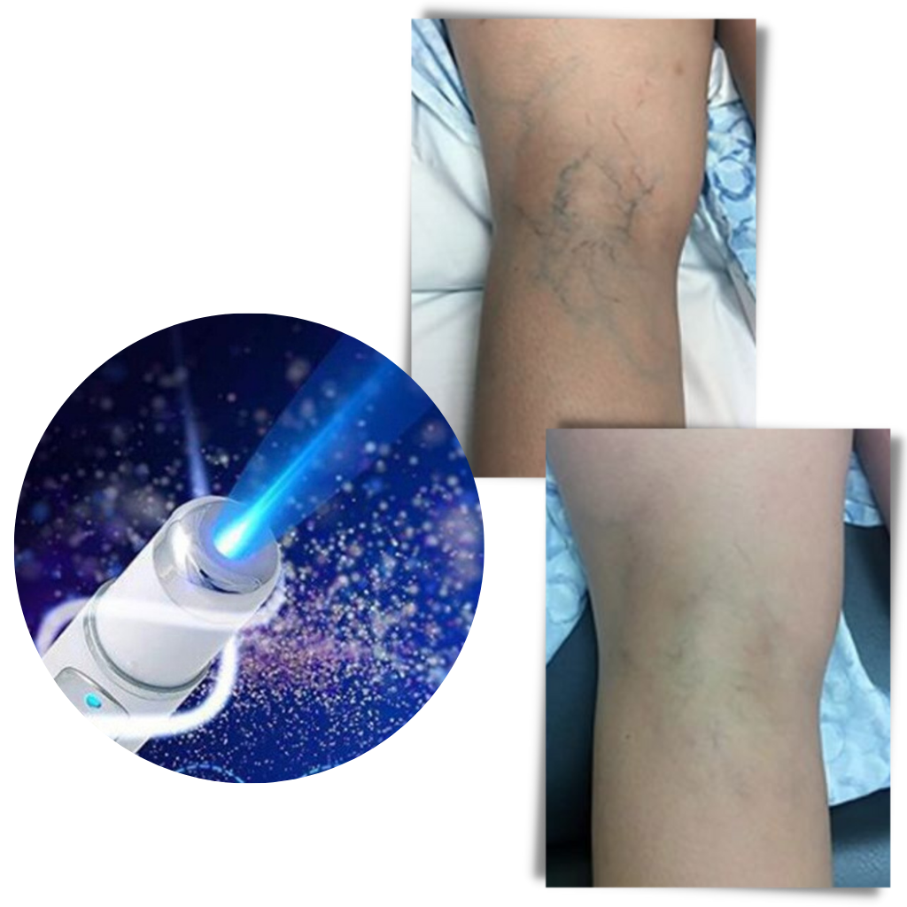 Blue light skin therapy pen